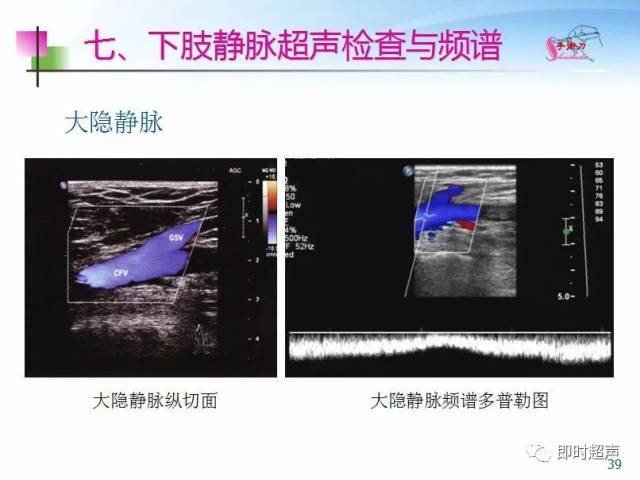 下肢血管的超声检查及正常声像图