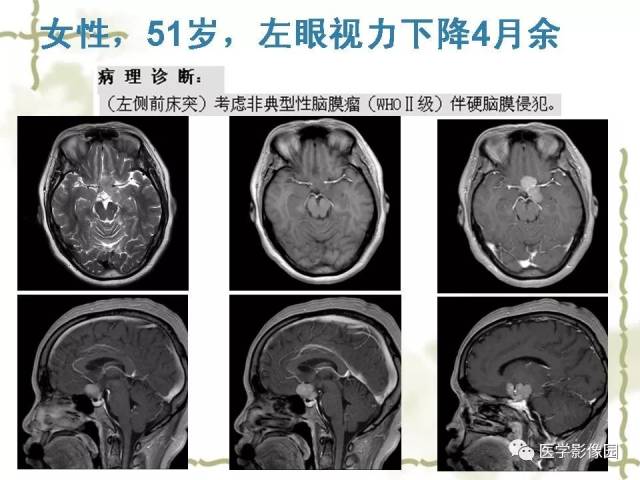 鞍区毛细胞型星形细胞瘤的mri诊断及鉴别诊断丨影像天地