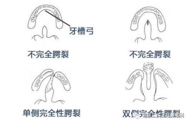 至今在国内外尚未见统一的腭裂分类方法,但根据硬腭和软腭部的骨质