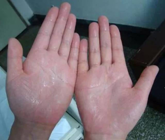 女性这几个部位出汗很危险99的人都还不知道
