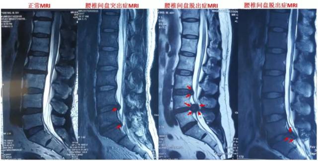 拒走"冤枉路",专家教你搞定腰椎间盘突出!