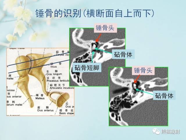 【柳澄讲坛】颞骨ct断层解剖(重要解剖结构的识别)