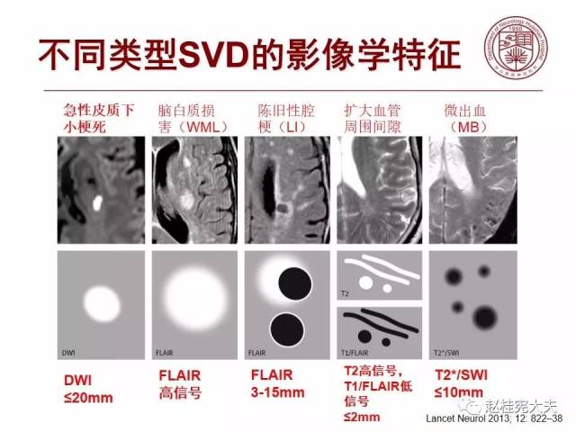 脑白质病之脑小血管病的诊断和鉴别诊断