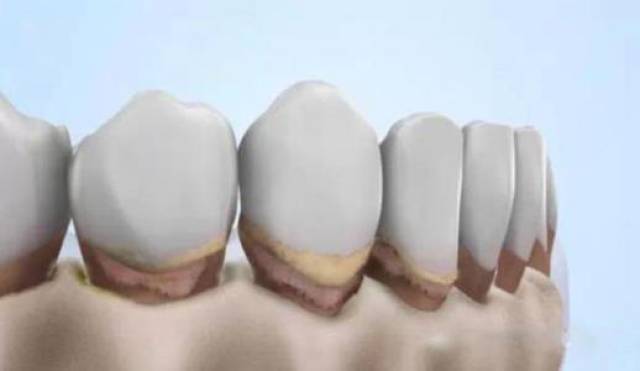 牙槽骨萎缩有哪些特征?