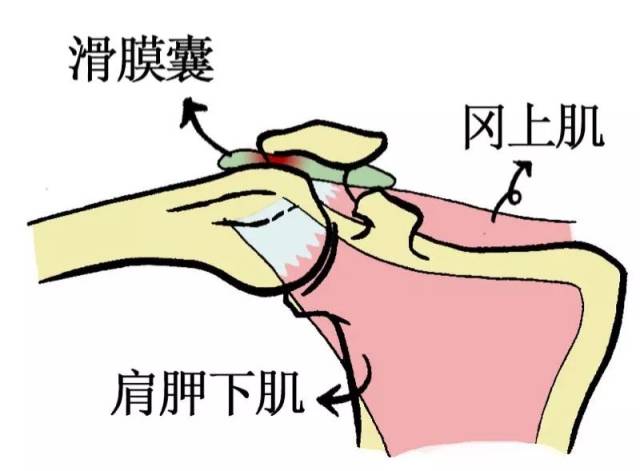 肩袖损伤的风险因素