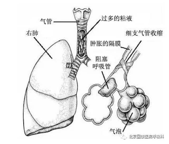 发展到肺心病 再不治就来不及了