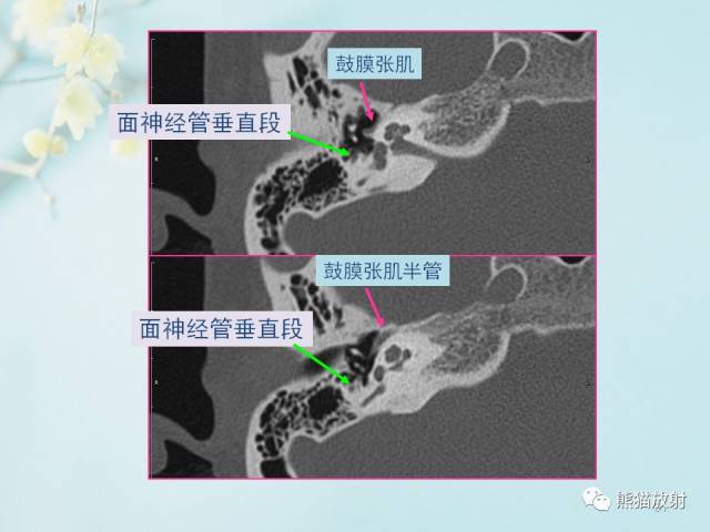 【柳澄讲坛】颞骨ct断层解剖(重要解剖结构的识别)