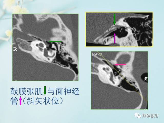 菜单栏内"各大系统"柳澄讲坛"面神经管鼓室段:起自面神经膝神经节