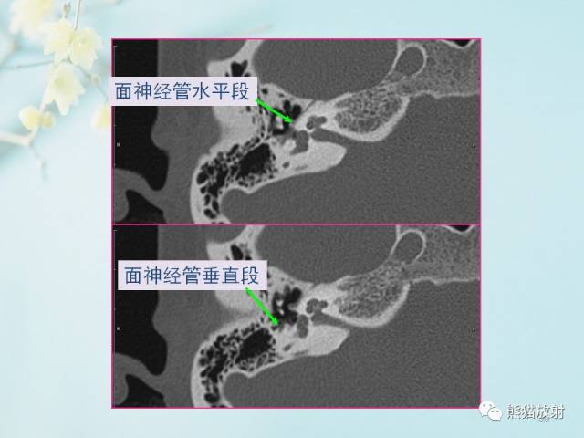 【柳澄讲坛】颞骨ct断层解剖(重要解剖结构的识别)