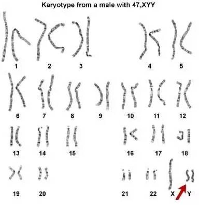 xyy核型是父亲精子形成过程中第二次减数分裂时发生y染色体不分离的