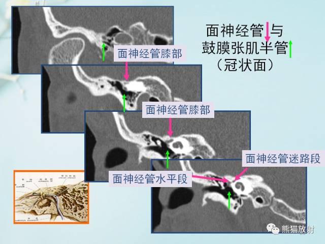 【柳澄讲坛】颞骨ct断层解剖(重要解剖结构的识别)