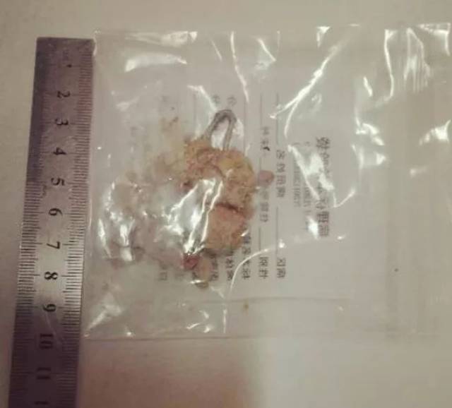 罕见!避孕环从子宫跑到了膀胱里,大便跑到了小便里