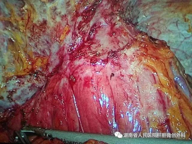 胰十二指肠切除标本移离后