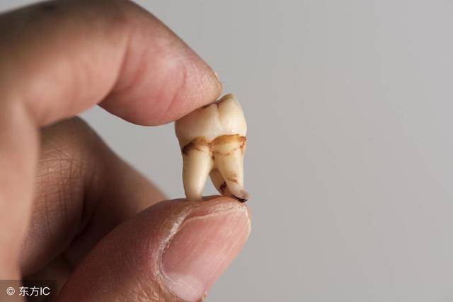 俗称的水平智齿,导致清洁不易,造成邻近的第二大臼齿也有蛀牙危机的话