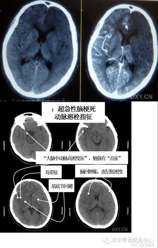 【年轻医师必学】超早期脑梗塞的ct影像表现及诊断