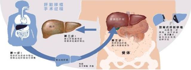 【117营养】肝移植患者的营养治疗