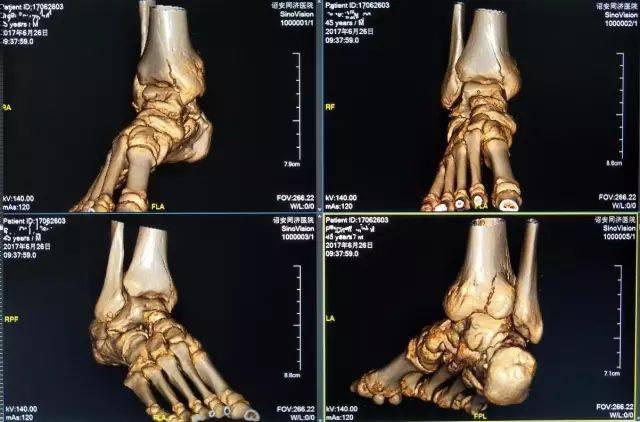 足部内踝骨骨折