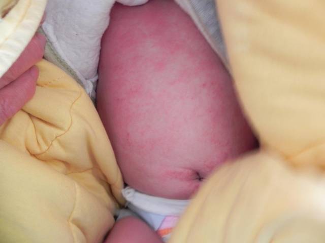 如何区分湿疹,热疹,急疹,荨麻疹及婴儿痤疮
