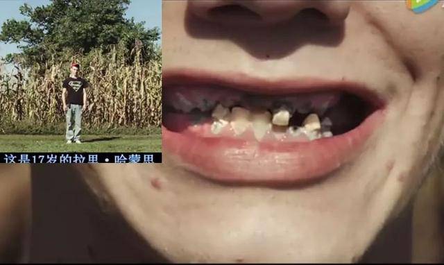 (纪录片中拉里·哈蒙思和他的牙齿) 纪录片中牙科医生说,当地这种