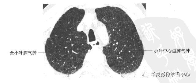 ③间隔旁肺气肿:肺泡管或肺泡囊肺气肿,位于胸摸下肺,肺小叶间隔旁
