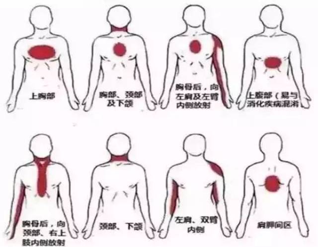 发作性胸痛 五招辨别心绞痛 心绞痛的疼痛部位主要在胸骨中段或上段