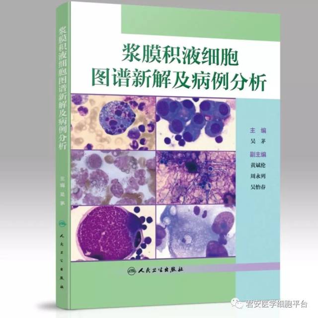 吴茅教授新作浆膜积液细胞图谱新解及病例分析免费送