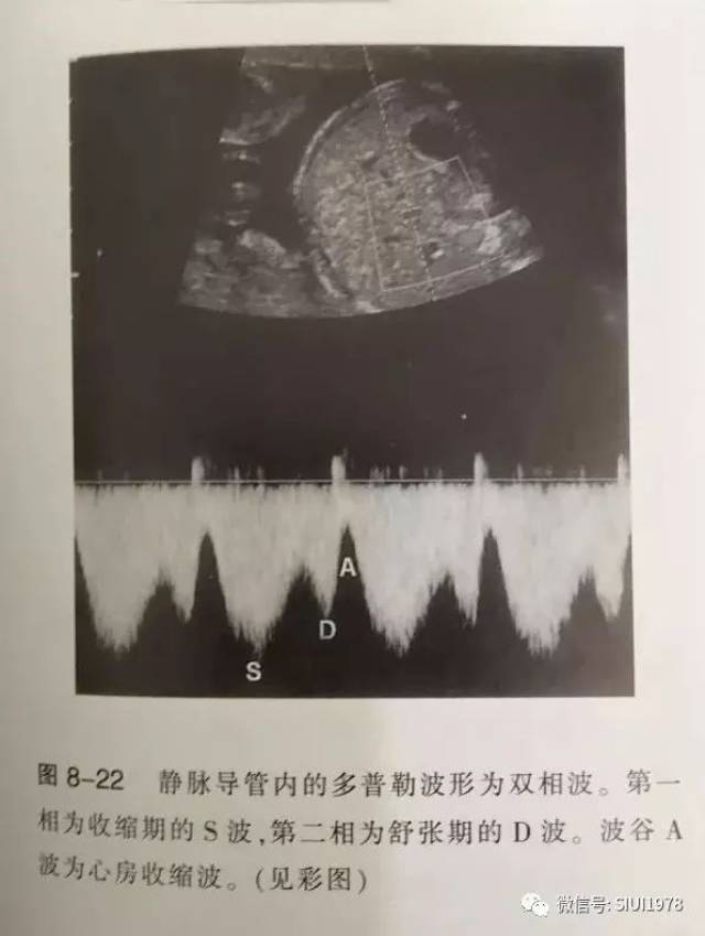 nt筛查时,怎样检查静脉导管?