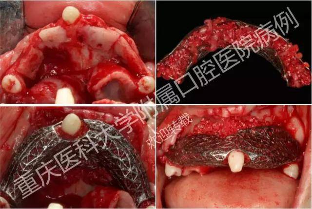 全国首例3d打印个性化钛网修复大面积牙槽骨缺损新鲜出炉!