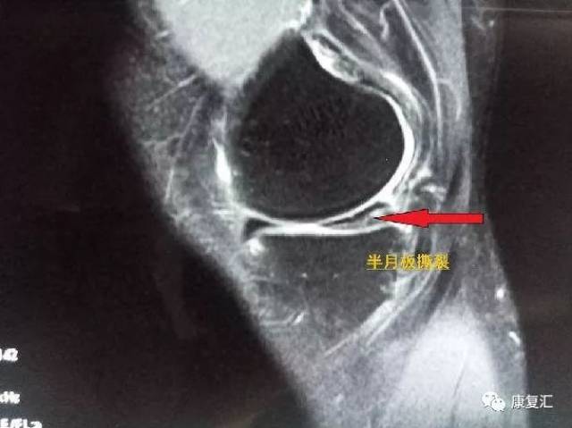 而且准确率不高,目前在在诊断半月板损伤方面基本已经 被核磁共振取代