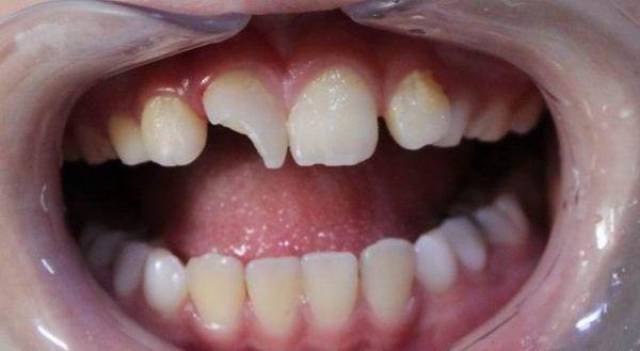 门牙受外力撞击缺损一角,第一有可能伤及牙本质,第二牙髓没有被感染