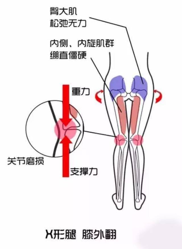 而x型腿在医学生被称为 膝外翻, 是指当两腿自然站立时,两侧的膝关节