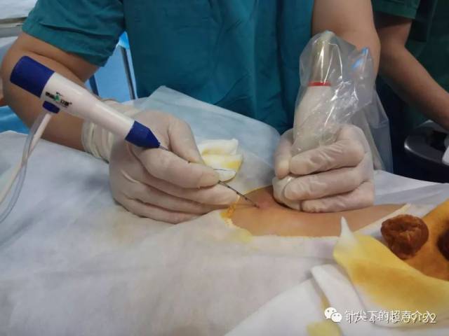 地区唯一专科----超微创介入超声