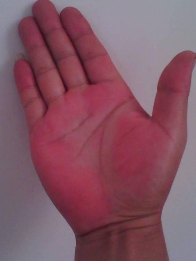 健康人的手掌应该是白里透着粉红,润泽,有弹性的,但如果你的手指比