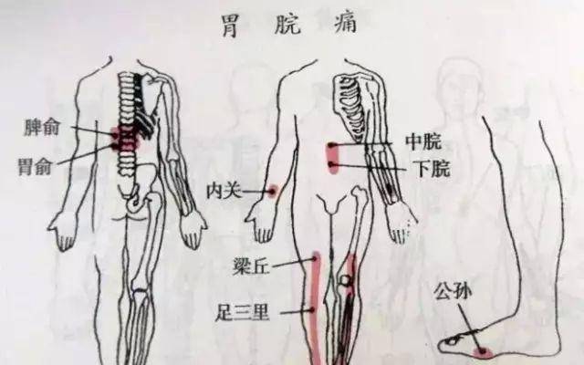 中医针灸,刮痧治疗急性胃痛方法