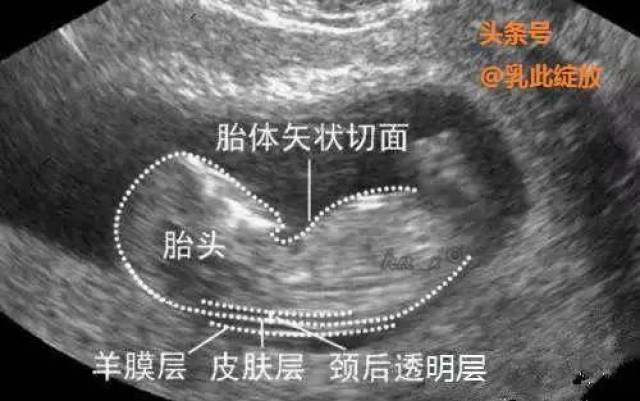 nuchal translucency thickness,简称nt):指胎儿颈椎水平矢状切面皮肤