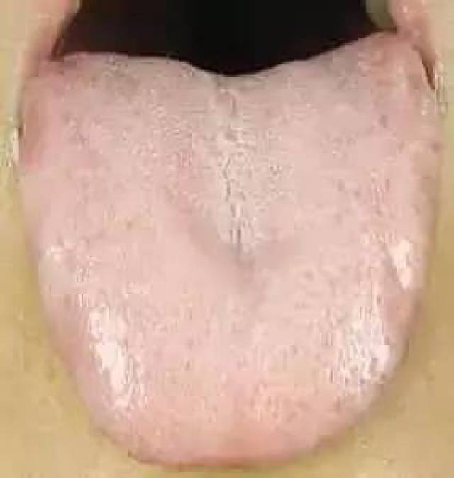 血虚 气血虚弱;整体舌少淡白,无血色;舌苔薄;舌下脉络不明显
