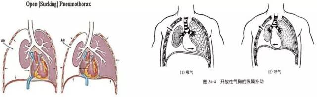 交通性(开放性)气胸 胸膜腔持续与外界相通,空气自由进入胸腔