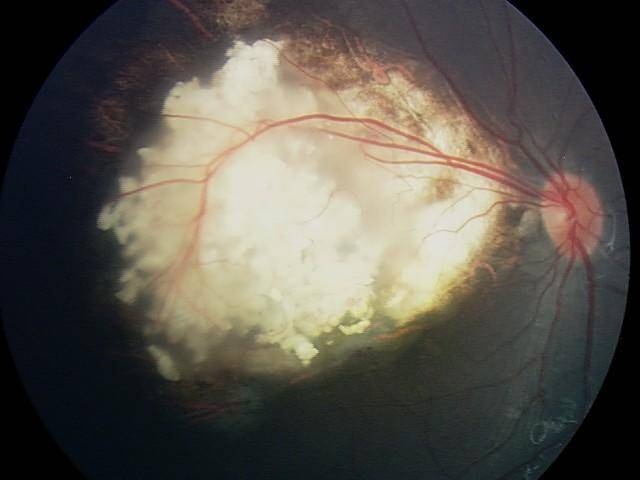 视网膜母细胞瘤