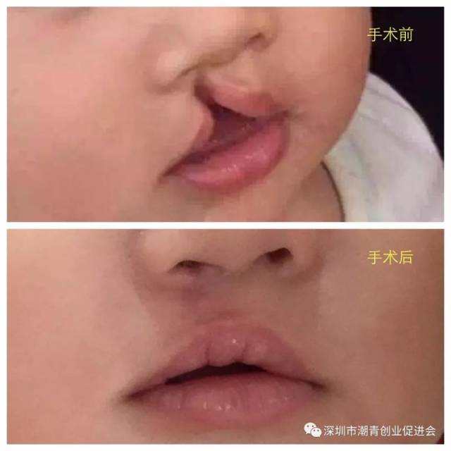 【微笑娃娃】喜讯:又有一批兔唇儿童治疗痊愈出院回家过新年,蔡文川