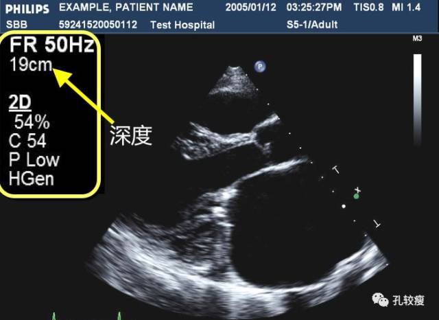 初学者如何打出漂亮的心脏超声图像