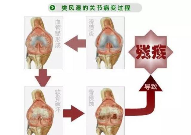 日本处方【特效类风湿,变形性关节炎药】