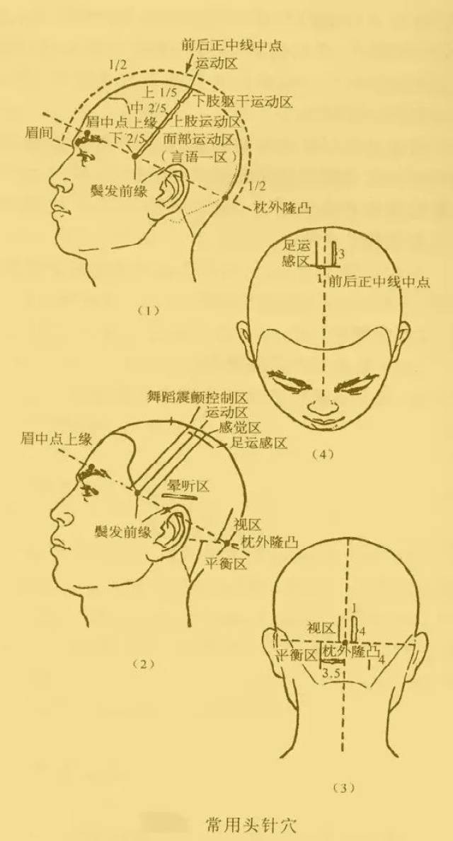 灸姐小讲堂丨从运动员受伤接受针灸疗法,看头部针刺疗法在临床上的