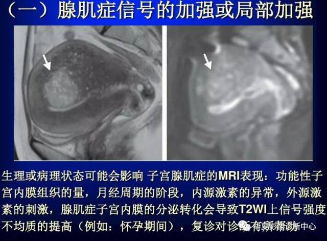 【影像基础】子宫腺肌症的mri表现