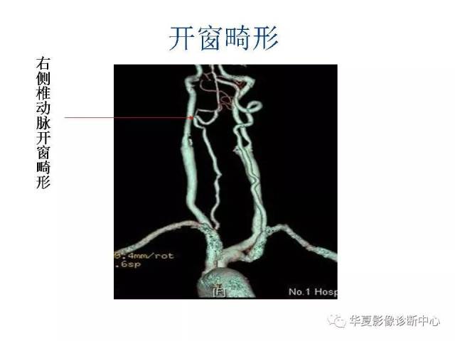 头颈部cta及头颈部血管常见变异