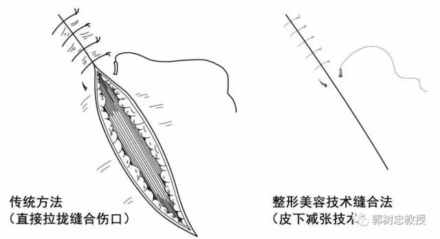 何谓伤口的美容缝合?