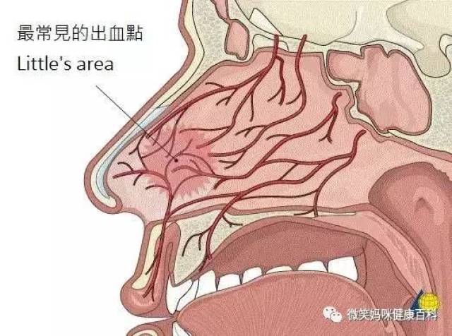 医生说|小孩鼻出血常见原因分析及应对策略