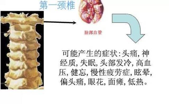 颈椎病的10个级别,你在哪一级?