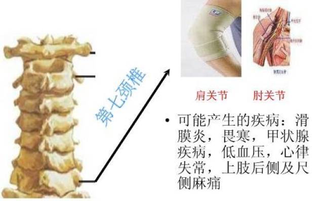 颈椎病的10个级别,你在哪一级?