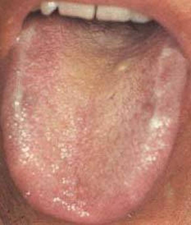 本图患者为肝硬化腹水,舌色淡紫,舌苔白腻,中部较厚,提示体内阳虚阴