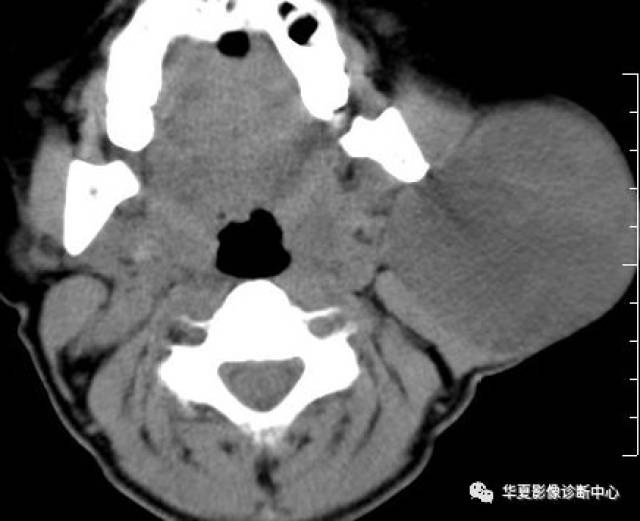 腮腺混合瘤--ct病例图片影像诊断分析